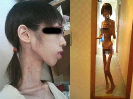 Naudzubillahi Min Dzaaliq, Begini Perempuan Derita Gizi Buruk Selfie Telanjang