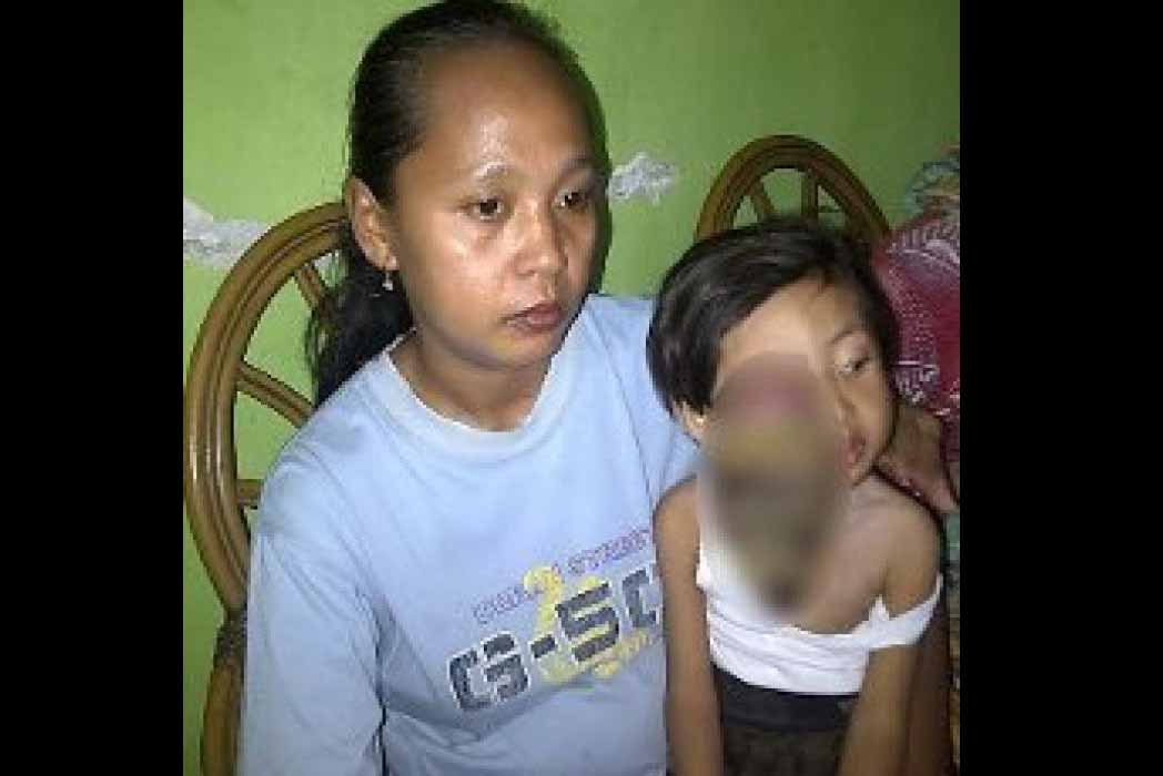 Bocah Penderita Tumor Mata di Mojokerto Akhirnya Meninggal