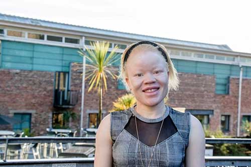 Dukun Afrika Incar Gadis Albino, Diambil Tulang dan Tubuhnya untuk Penguat Sihir